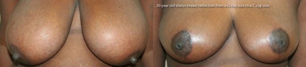 Breast Reduction Before & After - Dr. Thomassen