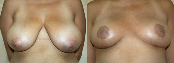 Breast Reduction Before & After - Dr. Thomassen