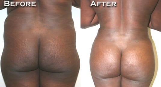 Buttock Augmentation Before & After - Dr. Thomassen