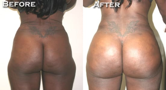 Buttock Augmentation Before & After - Dr. Thomassen