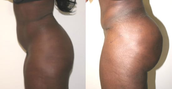Buttock Augmentation Before & After - Dr. Thomassen
