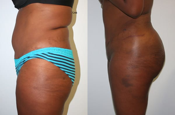 Buttock Augmentation Before & After - Dr. Thomassen