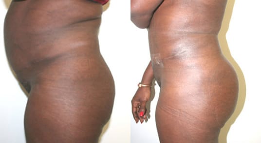 Buttock Augmentation Before & After - Dr. Thomassen