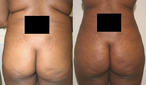 Buttock Augmentation Before & After - Dr. Thomassen