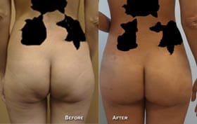 Buttock Augmentation Before & After - Dr. Thomassen
