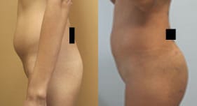 Buttock Augmentation Before & After - Dr. Thomassen