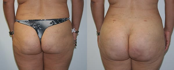 Buttock Augmentation Before & After - Dr. Thomassen