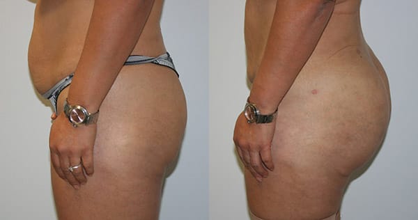 Buttock Augmentation Before & After - Dr. Thomassen
