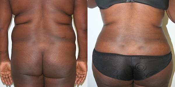 Buttock Augmentation Before & After - Dr. Thomassen