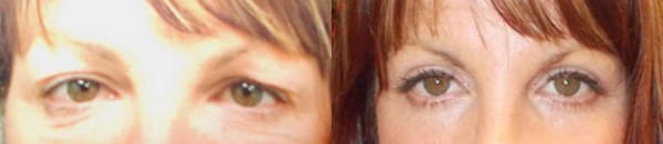 Eyelid Surgery Before & After - Dr. Thomassen