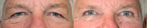 Eyelid Surgery Before & After - Dr. Thomassen