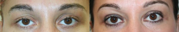 Eyelid Surgery Before & After - Dr. Thomassen