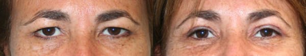Eyelid Surgery Before & After - Dr. Thomassen