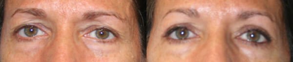 Eyelid Surgery Before & After - Dr. Thomassen