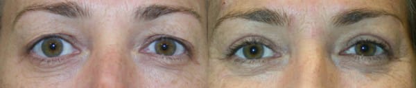Eyelid Surgery Before & After - Dr. Thomassen