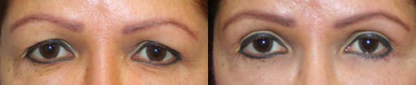 Eyelid Surgery Before & After - Dr. Thomassen