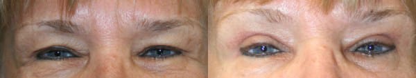 Eyelid Surgery Before & After - Dr. Thomassen