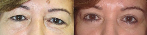 Eyelid Surgery Before & After - Dr. Thomassen