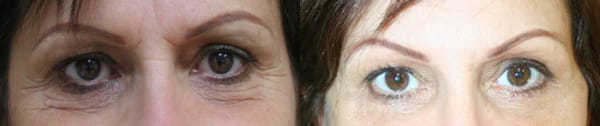 Eyelid Surgery Before & After - Dr. Thomassen