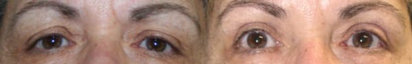 Eyelid Surgery Before & After - Dr. Thomassen