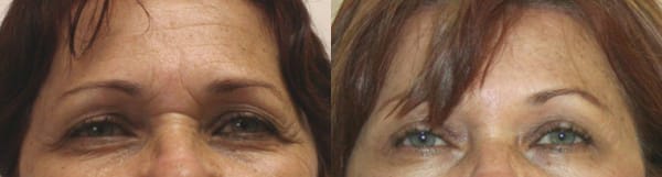 Eyelid Surgery Before & After - Dr. Thomassen