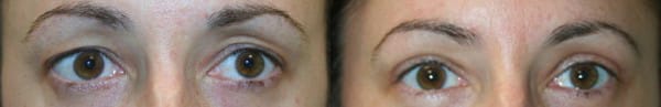 Eyelid Surgery Before & After - Dr. Thomassen