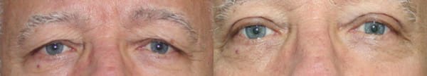 Eyelid Surgery Before & After - Dr. Thomassen