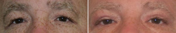 Eyelid Surgery Before & After - Dr. Thomassen