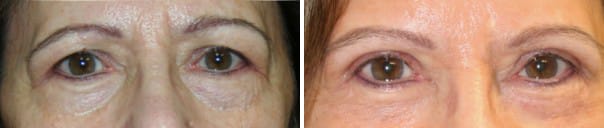 Eyelid Surgery Before & After - Dr. Thomassen