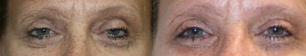 Eyelid Surgery Before & After - Dr. Thomassen