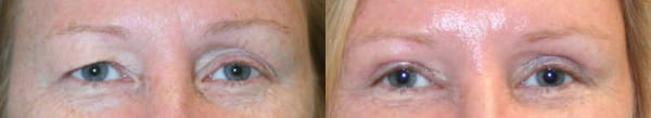 Eyelid Surgery Before & After - Dr. Thomassen