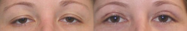 Eyelid Surgery Before & After - Dr. Thomassen