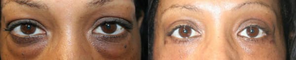 Eyelid Surgery Before & After - Dr. Thomassen