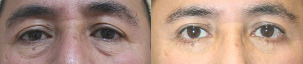 Eyelid Surgery Before & After - Dr. Thomassen