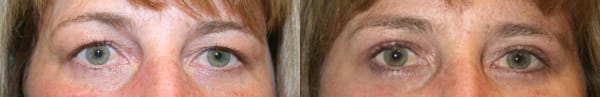 Eyelid Surgery Before & After - Dr. Thomassen
