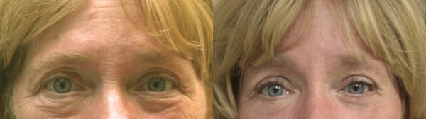 Eyelid Surgery Before & After - Dr. Thomassen