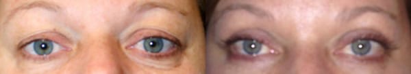 Eyelid Surgery Before & After - Dr. Thomassen