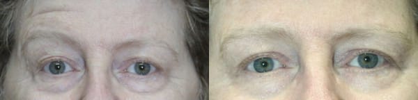 Eyelid Surgery Before & After - Dr. Thomassen