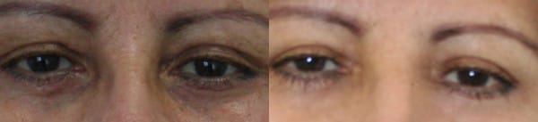 Eyelid Surgery Before & After - Dr. Thomassen