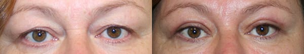 Eyelid Surgery Before & After - Dr. Thomassen