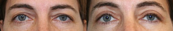 Eyelid Surgery Before & After - Dr. Thomassen