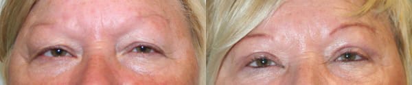 Eyelid Surgery Before & After - Dr. Thomassen