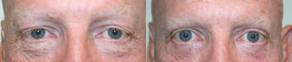Eyelid Surgery Before & After - Dr. Thomassen