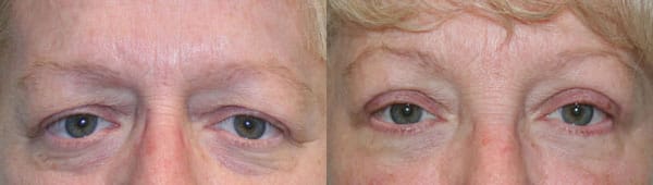 Eyelid Surgery Before & After - Dr. Thomassen