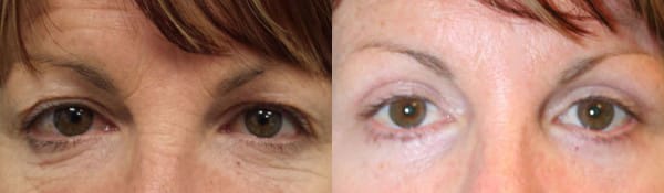 Eyelid Surgery Before & After - Dr. Thomassen