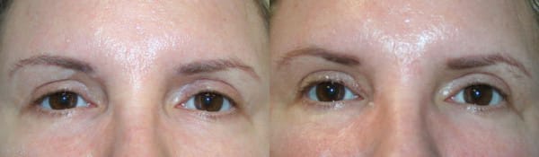Eyelid Surgery Before & After - Dr. Thomassen