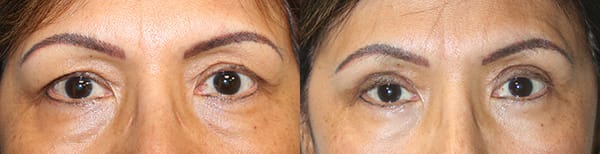 Eyelid Surgery Before & After - Dr. Thomassen