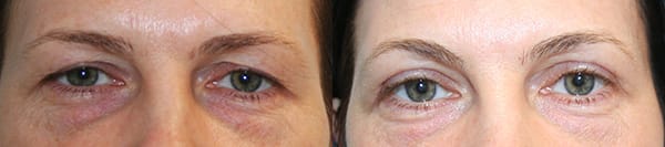 Eyelid Surgery Before & After - Dr. Thomassen