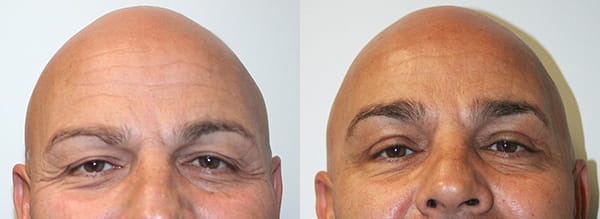 Eyelid Surgery Before & After - Dr. Thomassen