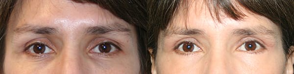 Eyelid Surgery Before & After - Dr. Thomassen